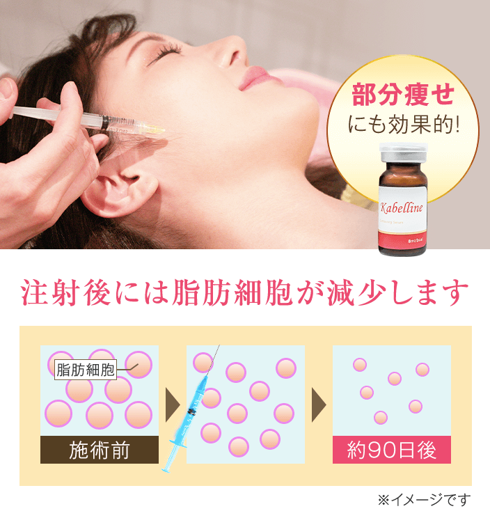 脂肪溶解注射「カベリン」