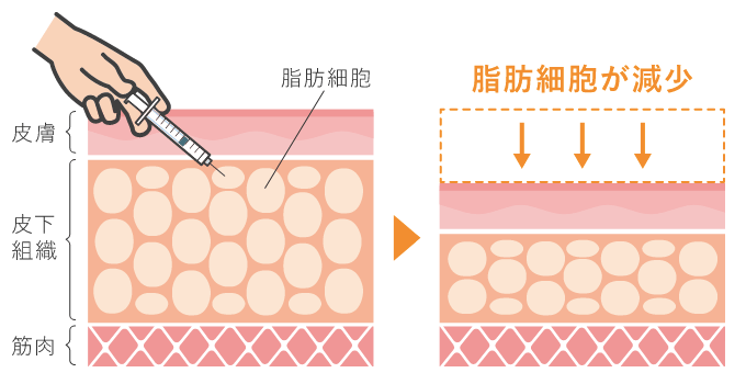 ミラクリニックの脂肪溶解注射