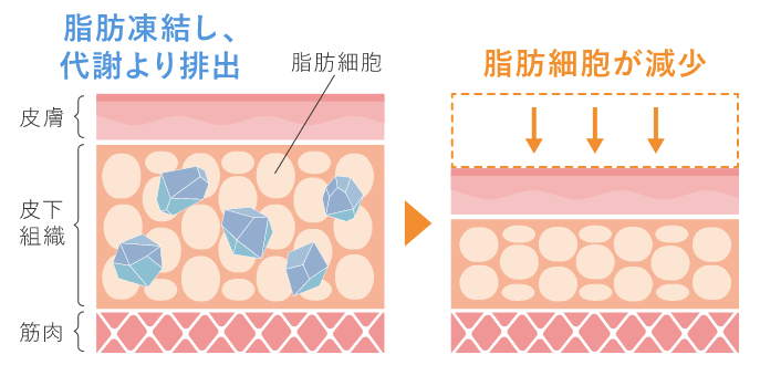 脂肪凍結機器で半永久的な痩身効果