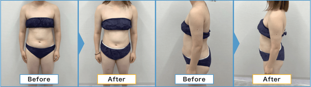 ミラクリニック、医療痩身ダイエットの症例写真