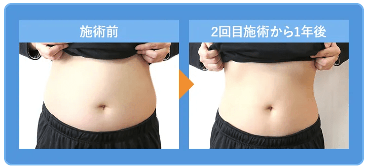 ミラクリニックのGLP-1ダイエットでリバウンド防止！