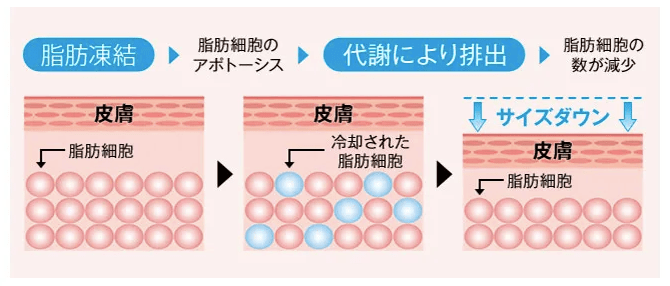ディオクリニックの脂肪冷却装置