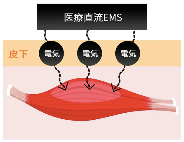 ディオクリニックの医療直流EMS