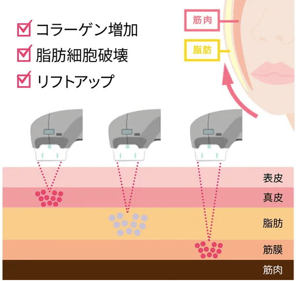 ディオクリニックの医療フェイスハイフ