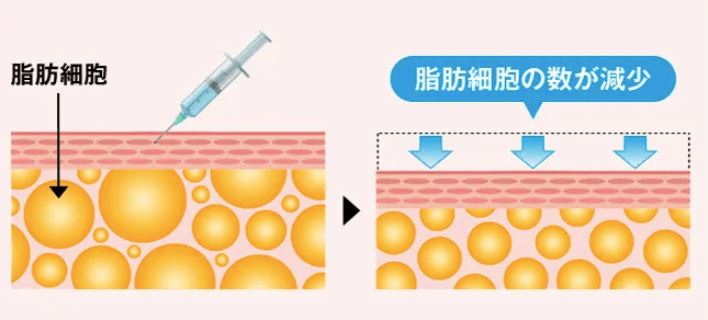 ディオクリニックの脂肪溶解注射